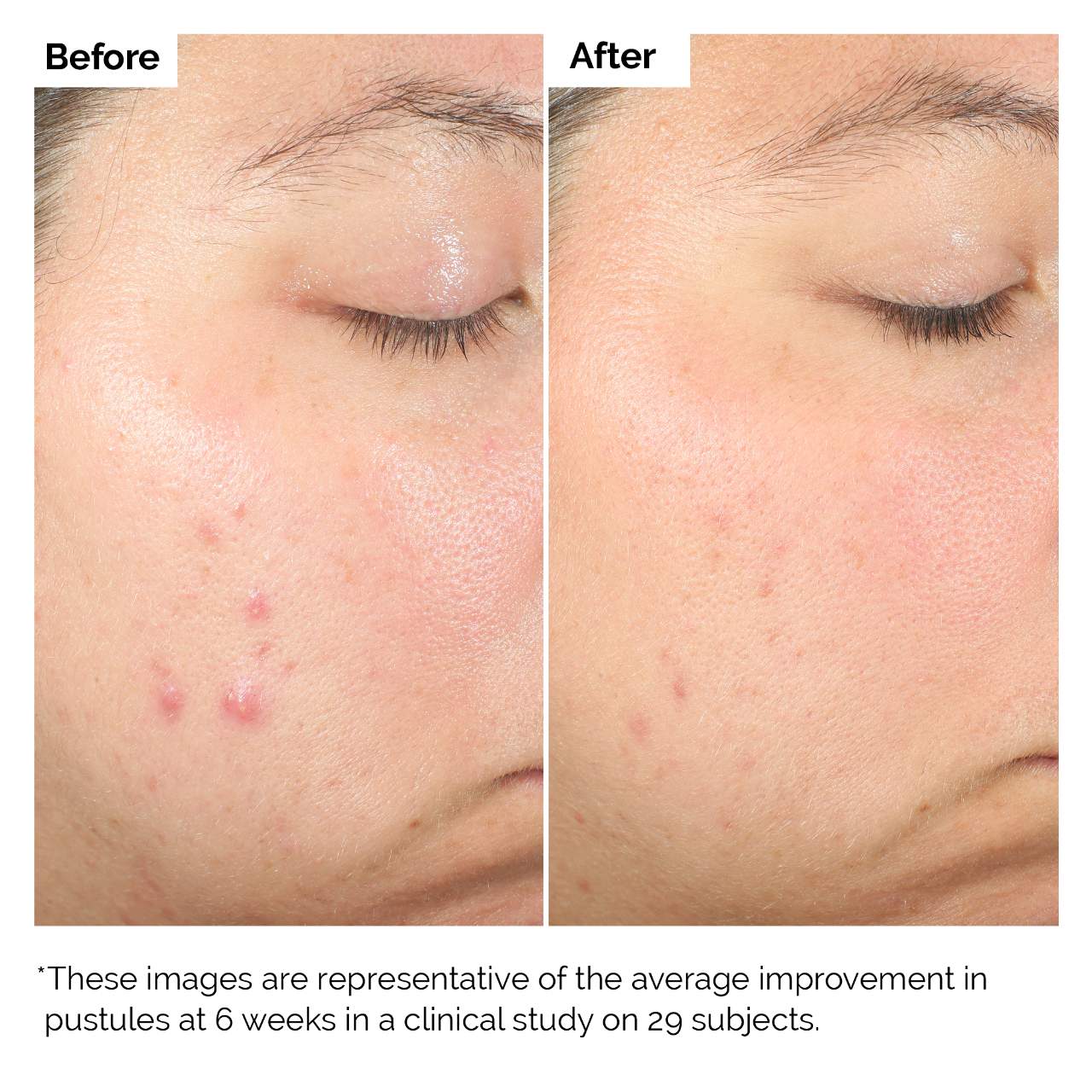 The Ordinary - Salicylic Acid 2% Exfoliating Blemish Solution